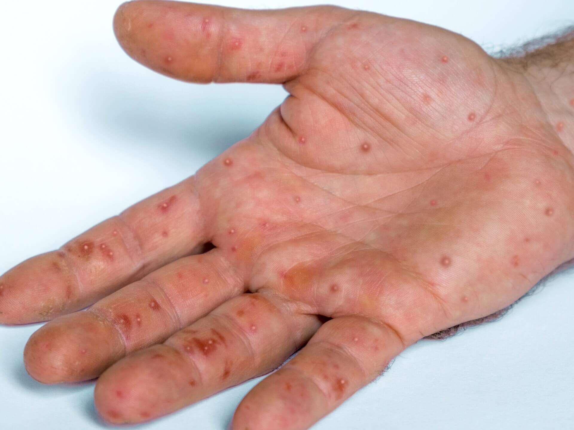 Monkeypox Cropped