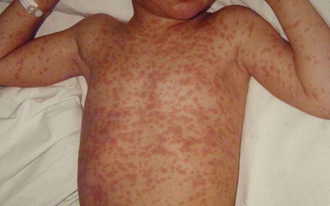 NT Health issues measles alert for Greater Darwin region