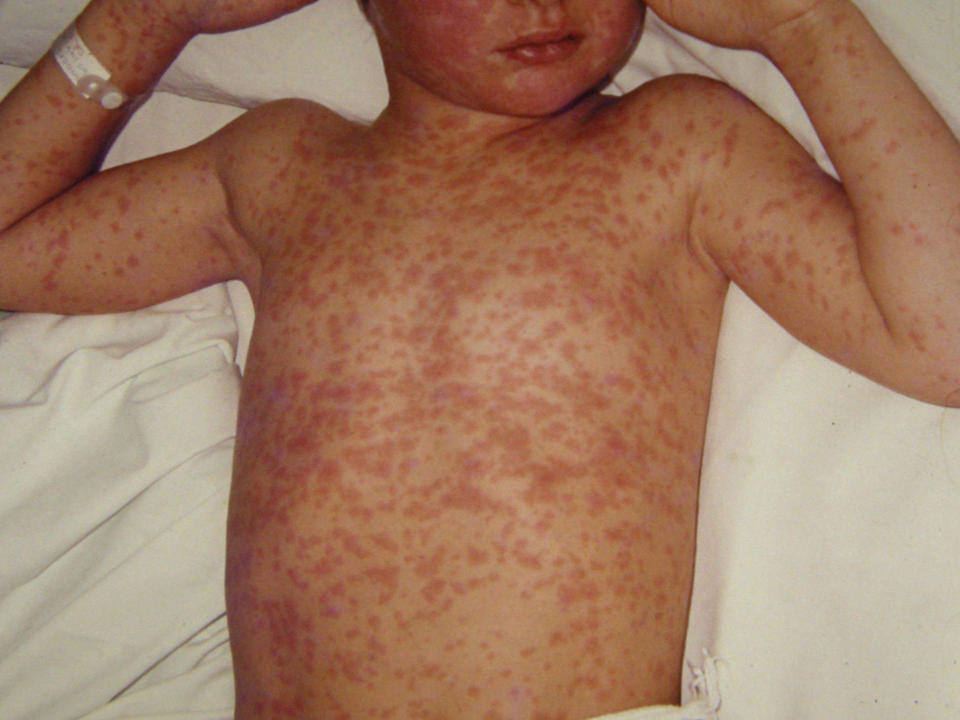 measles12-PIC Cropped