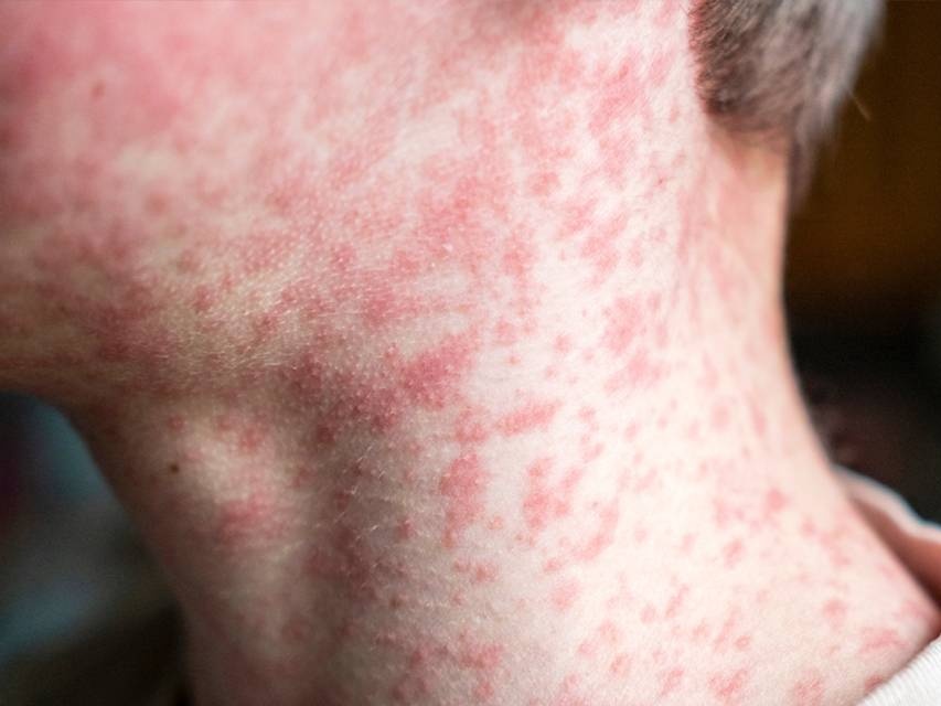 Measles Cropped